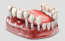 How Much Are Partial Dentures?