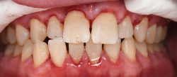 Deep Cleaning Teeth Before And After