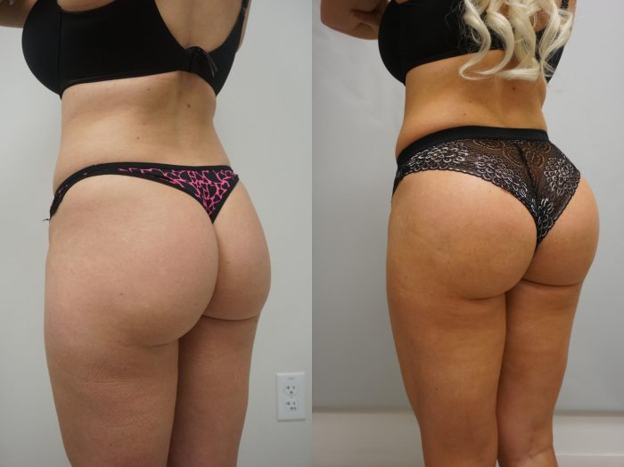 Brazilian Butt Lift Surgery Before and After