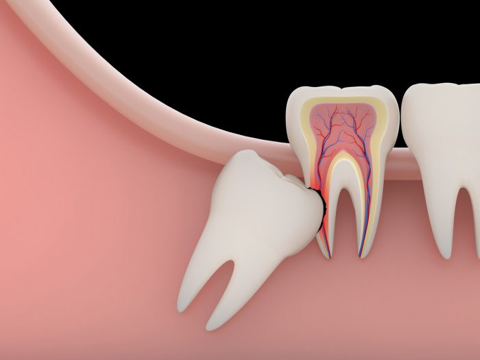 Infected Wisdom Tooth Extraction