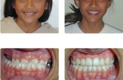 Braces Colors That Make Your Teeth Look Whiter