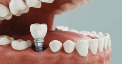 Affordable Dental Implants in Houston TX