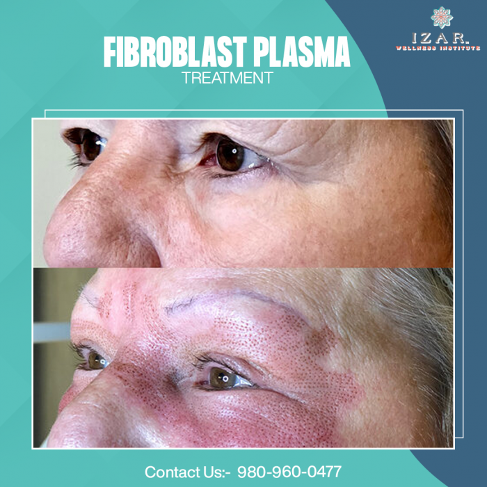 Best Fibroblast Plasma Treatment