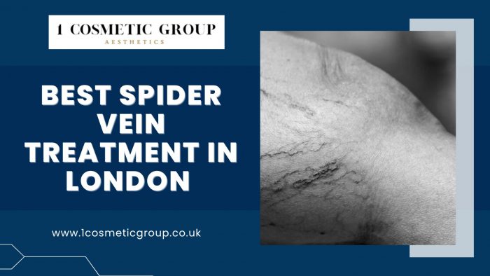 Best Spider Vein Treatment in London