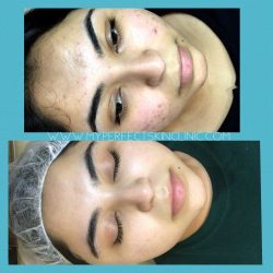 Cystic Acne Treatments – My Perfect Skin Clinic
