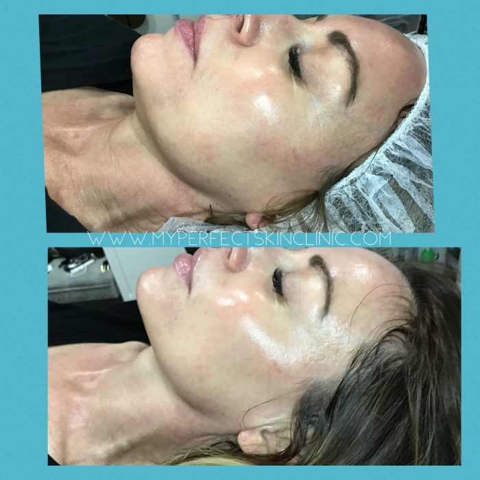 Facials Treatments by My Perfect Skin Clinic
