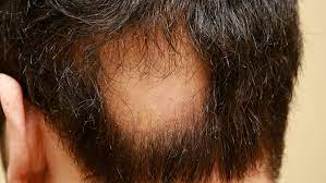 Stem Cell Treatment for Alopecia Areata (Hair Loss)