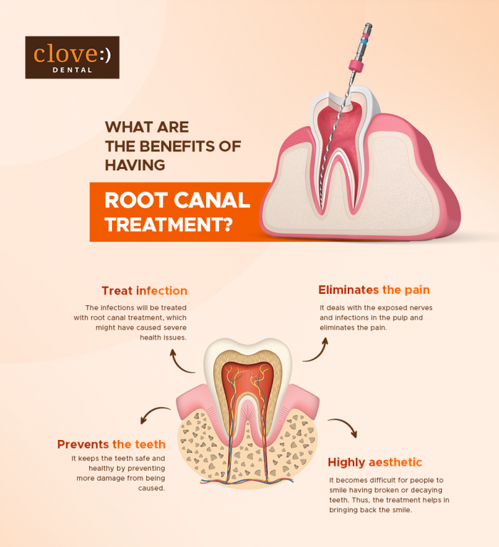 What are the Benefits of Having Root Canal Treatment