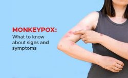 Monkey pox : Symptoms and Treatment