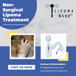 Are You Looking For Non Surgical Lipoma Removal In The United States?