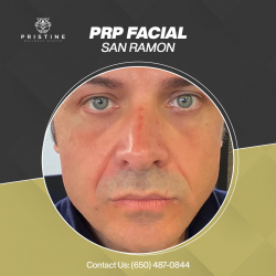 PRP Facial in San Ramon