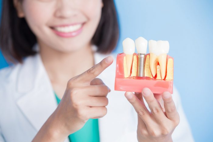 Get Treated With Implant-Supported Dentures Today!