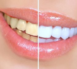 Teeth Whitening Services in Carmel Valley – Gentle Dentistry