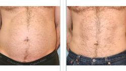 Does laser liposuction really work?