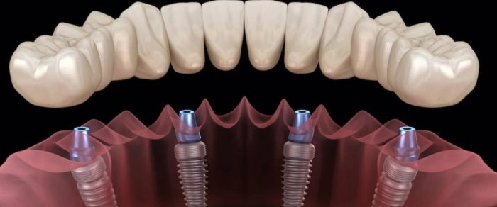 Dental Implant Options Near Me