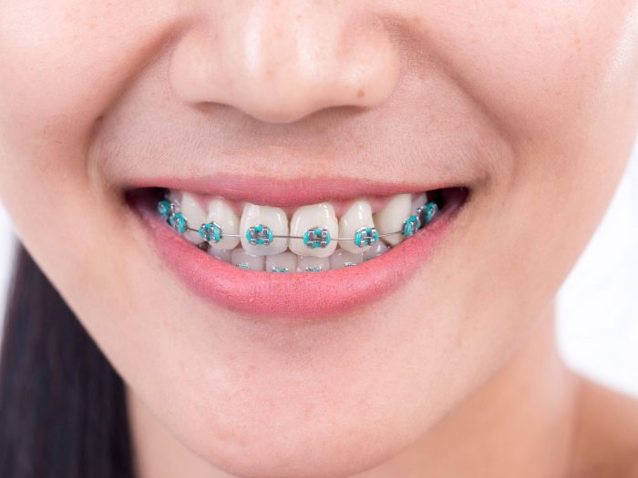 Best Orthodontist Specialists in Hollywood, Fl