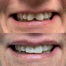 Fix Cavity on Front Tooth | Composite Front Tooth Cavity Filling or Bonding