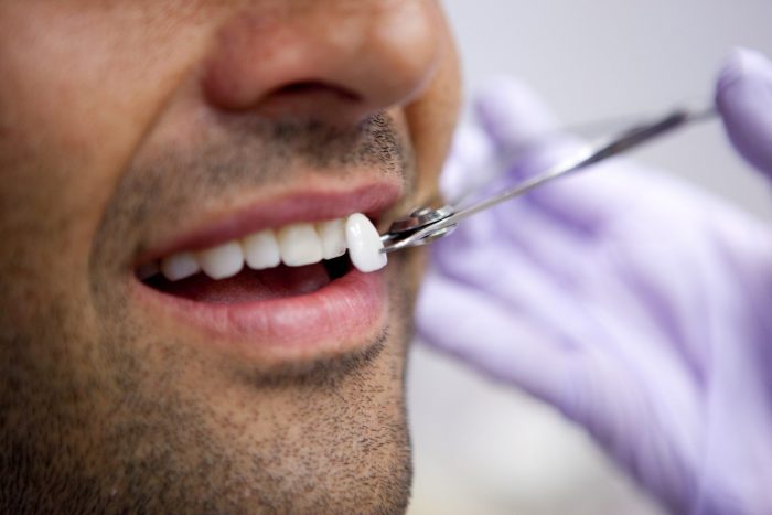 Dental Veneers In Uptown