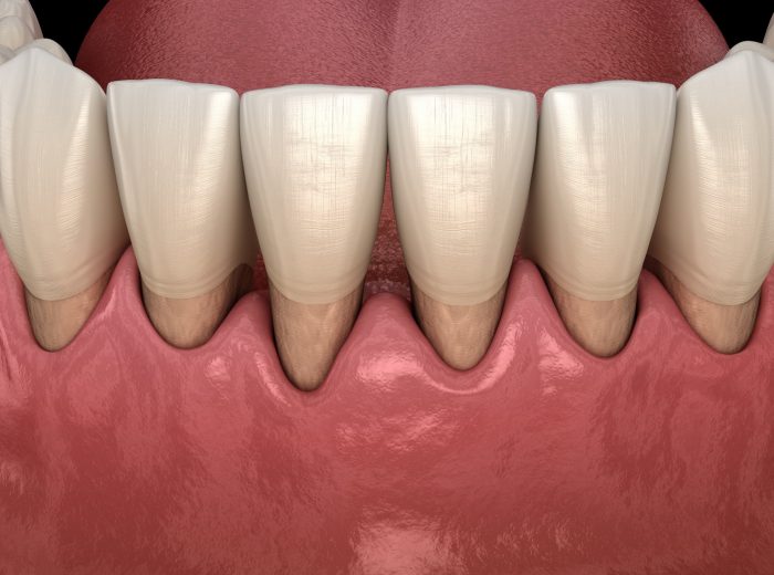 Gingivitis Treatment Dentist Near Me