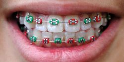 How To Find The Best Color For Your Braces With Braces Color Wheel