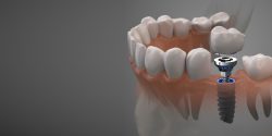 Affordable Dental Implants in Houston