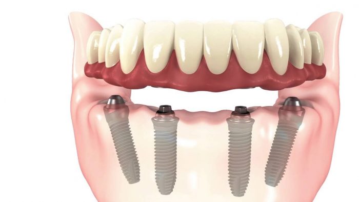 All On 4 Dental Implants in Aventura