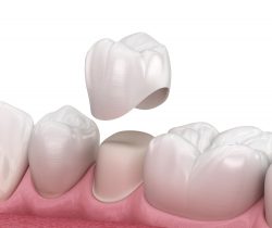 Same Day Dental Crowns Cost