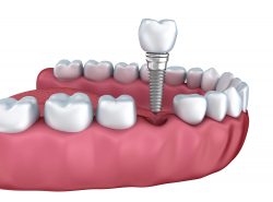 Dental Implants Sunny Isles FL
