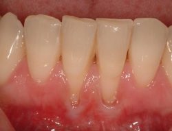 Gingival Recession Treatment in Houston