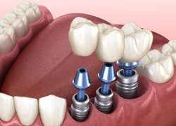 Dental Implants Specialist in Houston TX