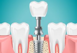 Dental Implant Surgery in Houston TX