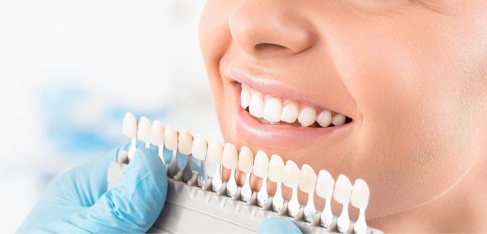 Miami Beach Teeth Whitening Treatment