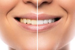 Teeth Whitening Treatment in Miami Fl