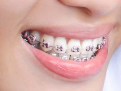 Choose the Best Colors for your Braces