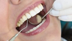 Dental Abscess Treatment Cost | Gum Abscess Treatment in Houston