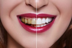 Teeth Whitening Dentist Cost