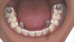 Full Mouth Dental Implants Procedure