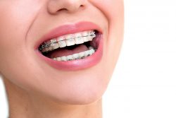 Find Local Orthodontist Near Me For Braces