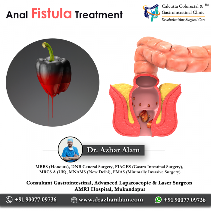 Fistula Doctor in Kolkata | Best Treatment for Fistula