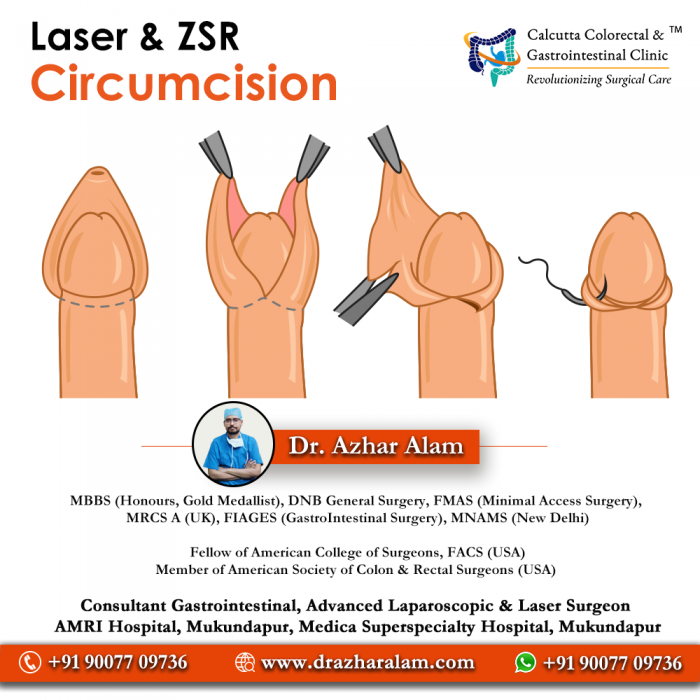 Circumcision Doctor in Kolkata | Laser Circumcision Surgery