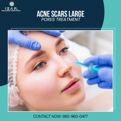 Acne Scars Large Pores Treatment