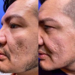 Acne scars | Before & After