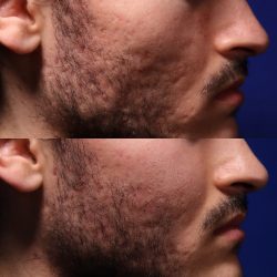 Acne scars before and after – laser treatment