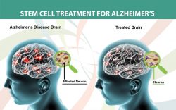 Alzheimer’s Treatment Through Stem Cell