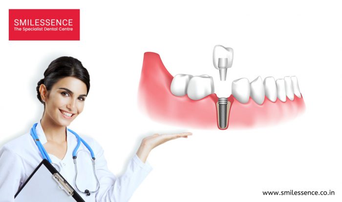Best Dental Implants Clinic in Gurgaon