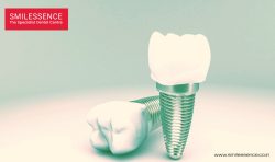 Dental Implants Services By Smilessence in Gurgaon