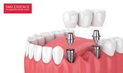Smilessence For Dental Implants Services