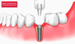 Services For Dental Implants in Gurgaon