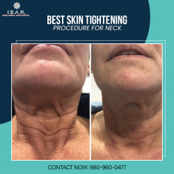 Best Skin Tightening Procedure For Neck
