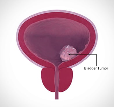 Bladder Cancer Surgery Cost in Delhi | Delhi Urology Hospital | Dr. Niren Rao